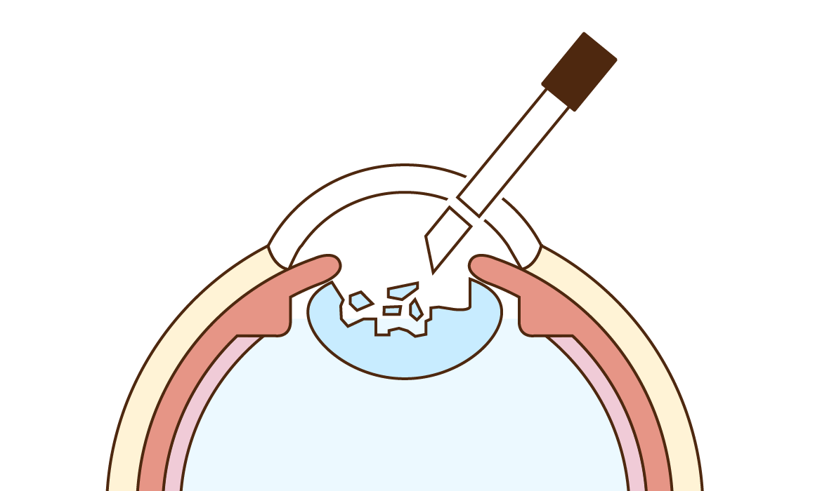 水晶体乳化吸引
